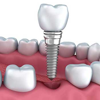 Sandstone Dental | North Calgary Dental Implants