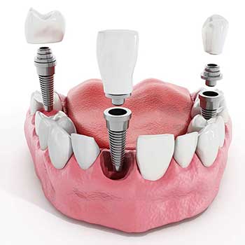 Sandstone Dental | North Calgary Dentist | Multiple Dental Implants