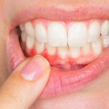 Sandstone Dental | North Calgary Periodontal Gum Disease