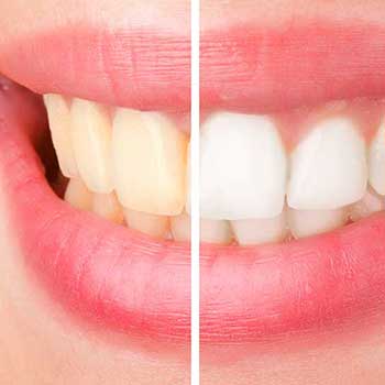 Sandstone Dental | North Calgary Teeth Whitening