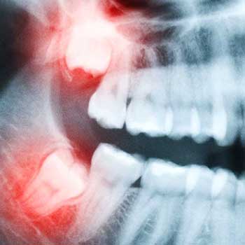 Sandstone Dental | North Calgary Dentist | Wisdom Teeth Extraction