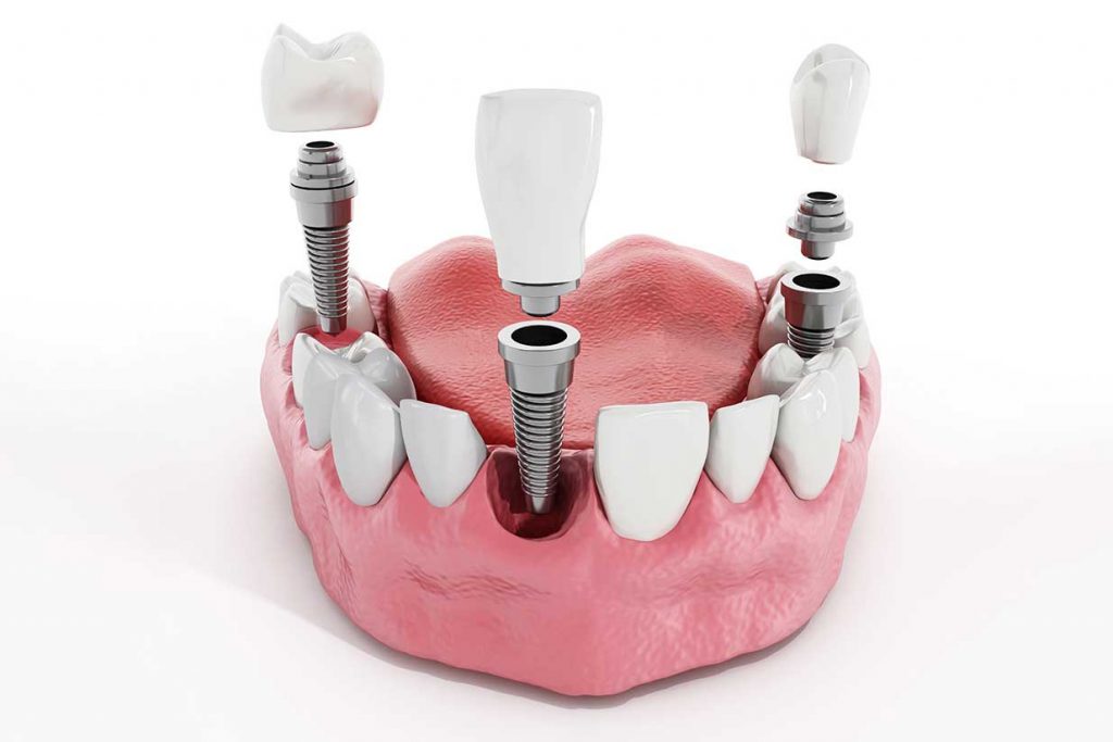 dental implants in nw calgary