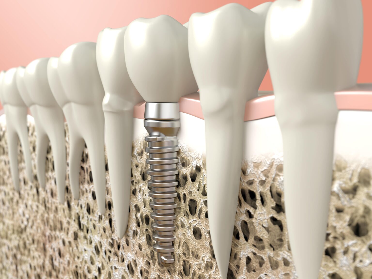 dental implants near you