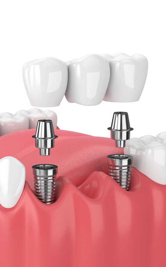 implant supported crowns and bridges in nw calgary