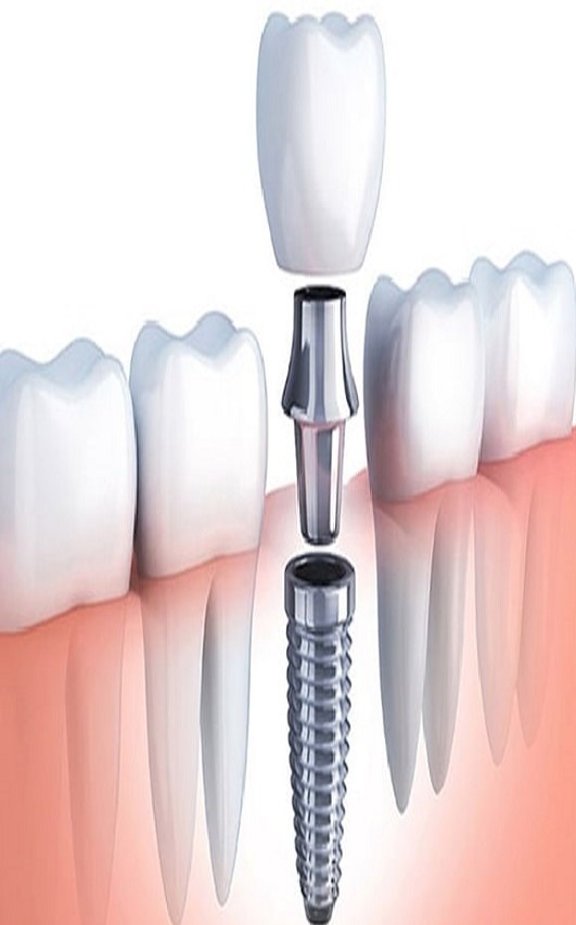 implant supported crowns bridges