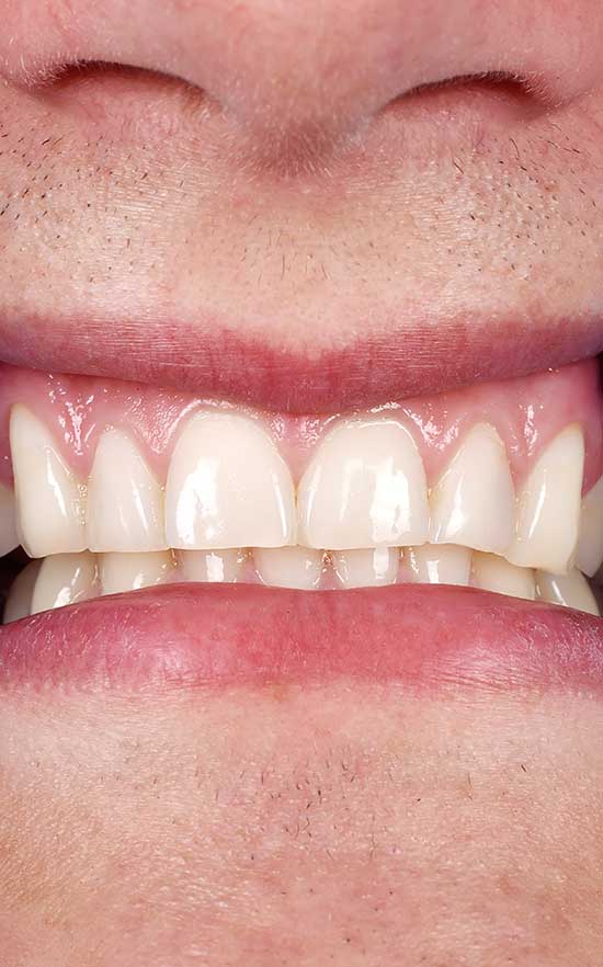 symptoms of gum disease