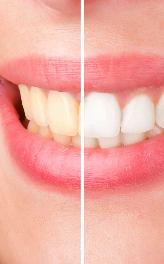 teeth whitening in nw calgary