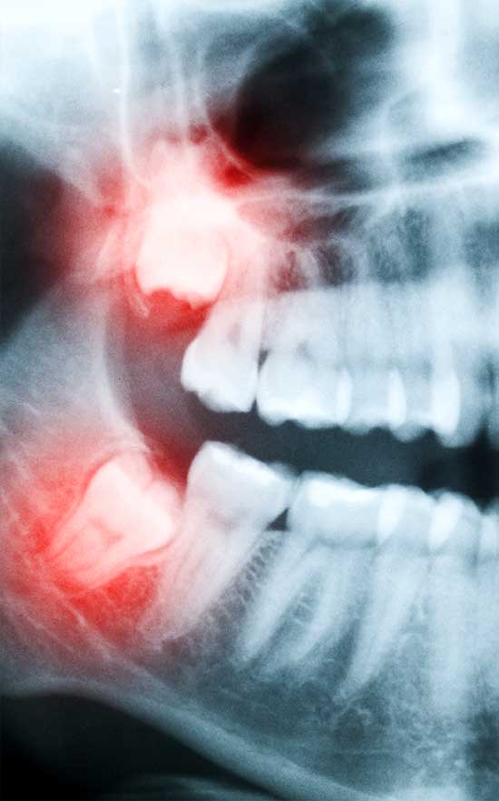 wisdom tooth extractions in nw calgary