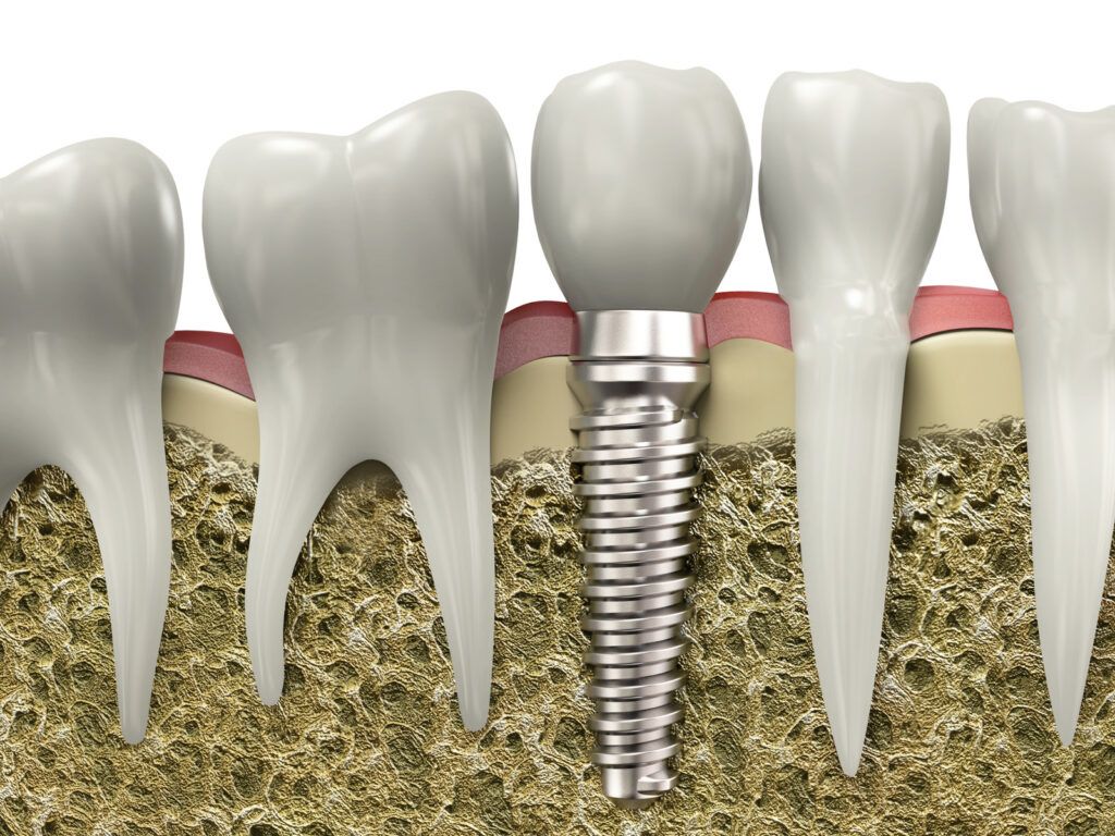 Dental Implants in Calgary