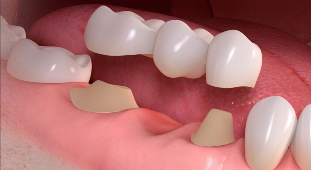 dental bridges in calgary
